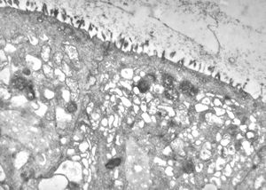 celiakia celiakia